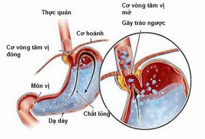 Hẹp môn vị làm dạ dày giãn to, thức ăn tồn đọng nhiều trong dạ dày và có hình ảnh “tuyết rơi”