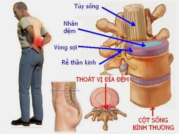 Hình ảnh thoát vị đĩa đệm