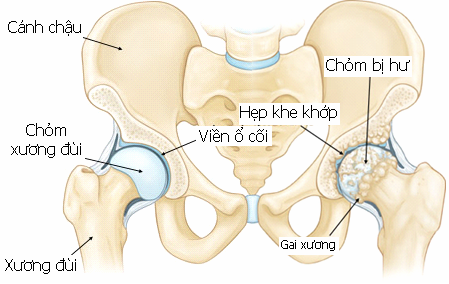 Thoái hóa khớp háng là bệnh lý chủ yếu gặp ở người lớn tuổi