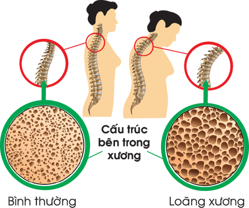 Bệnh loãng xương ở độ tuổi trung niên